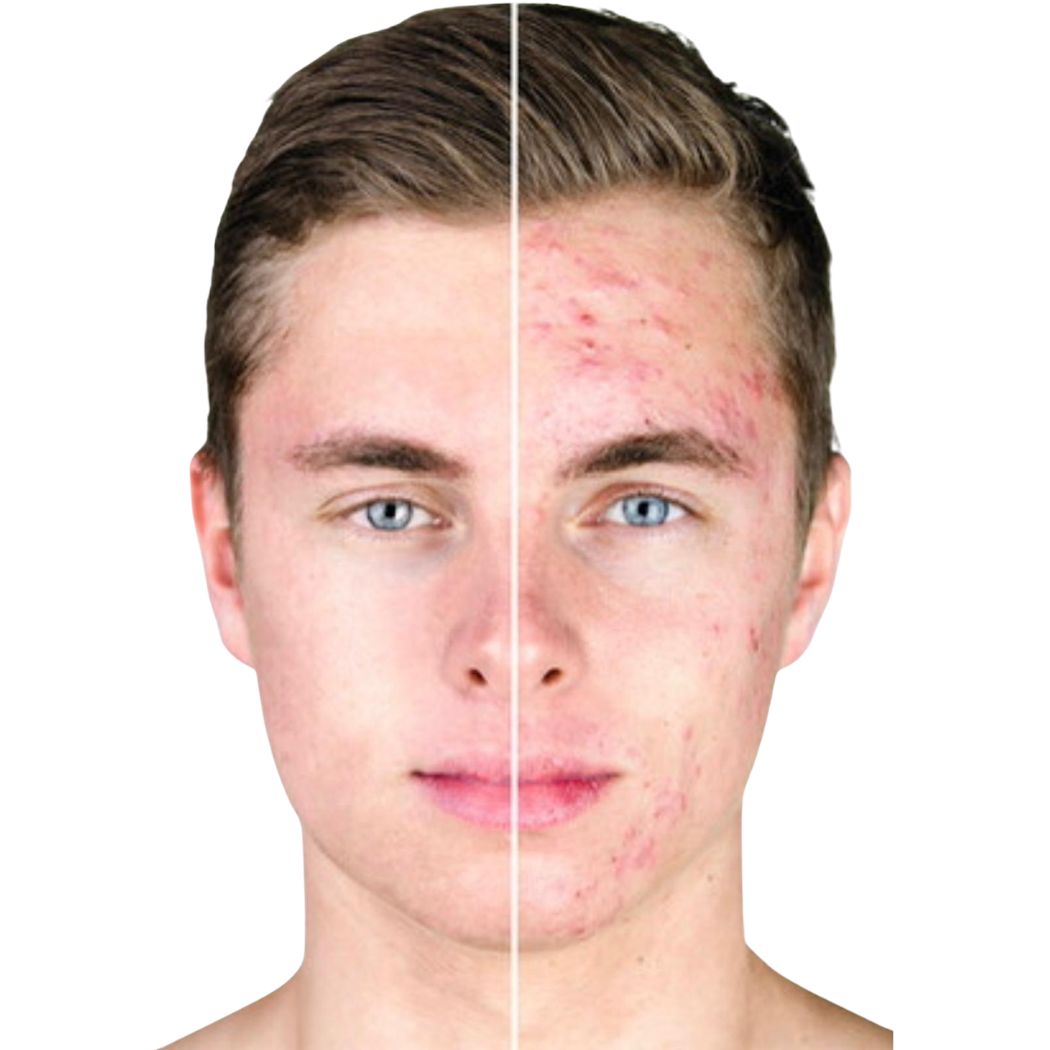 Problemhaut Behandlung - Pure Skin by Jean-Pascal Rheine